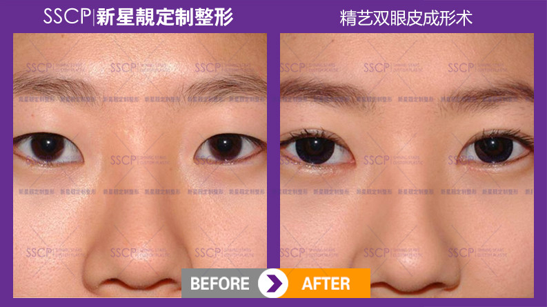 双眼皮修复专家刘风卓：双眼皮修复案例和收费标准