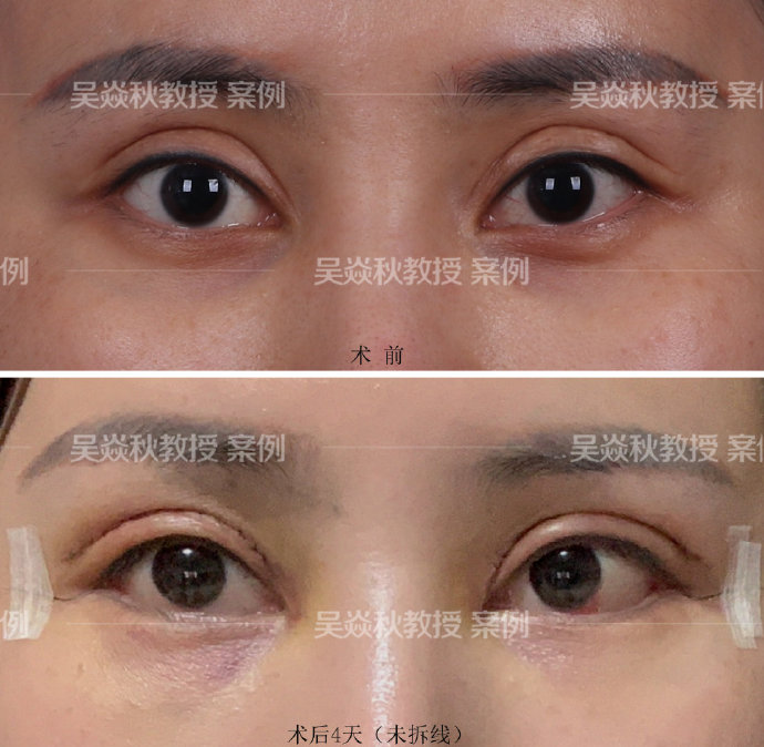 吴炎秋王振军谁修复双眼皮更好