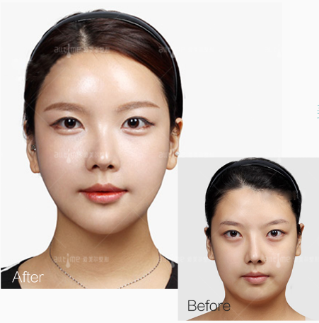 王曼姬_福州爱美尔整形医院微整专家