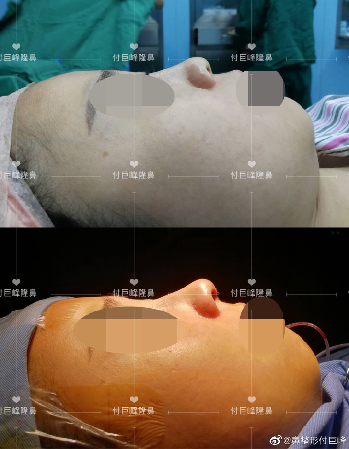 付巨峰做鼻子怎么样，有案例吗
