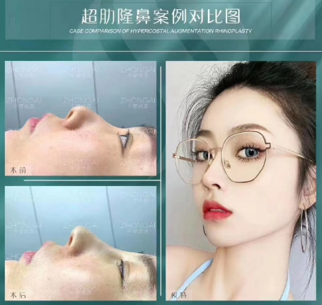 武汉付荣峰修复鼻子怎么样