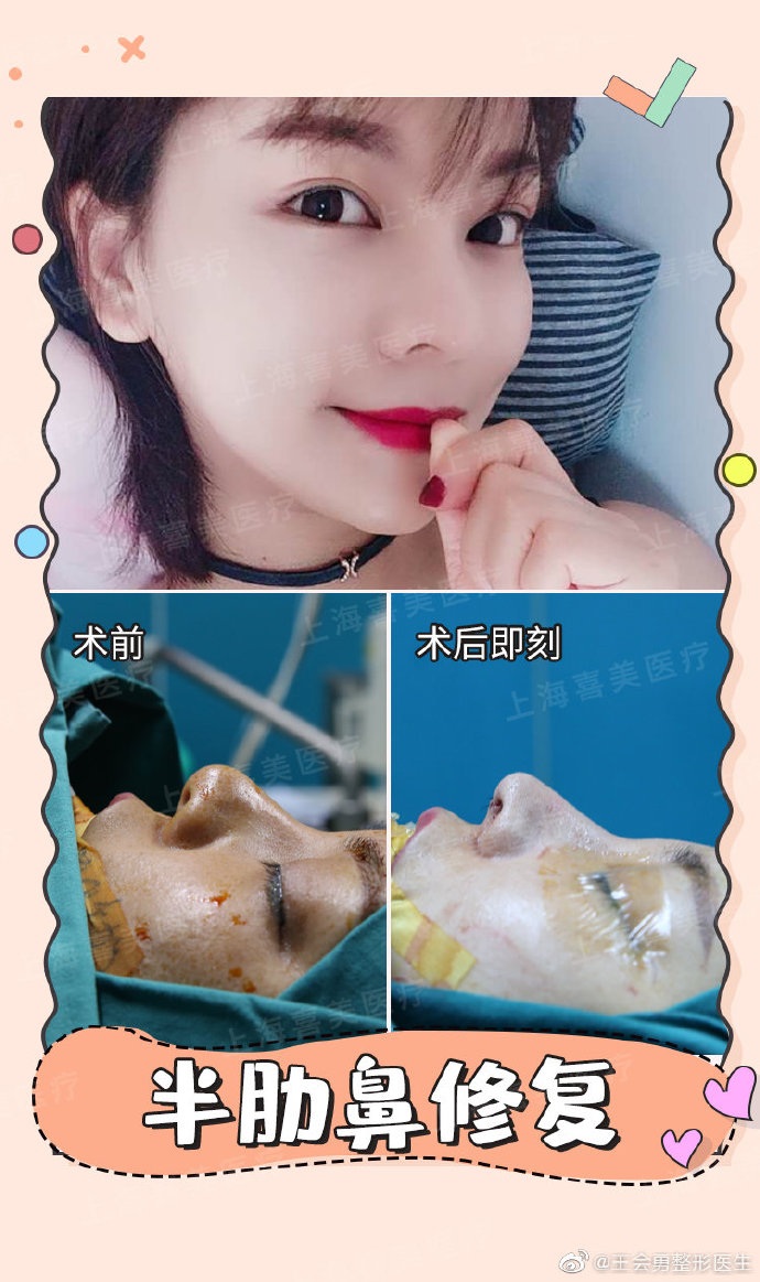 上海王会勇和何晋龙谁做的鼻子好？