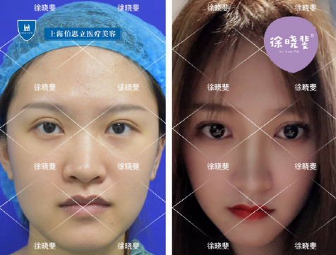 徐晓斐和杨亚益哪个做眼综合效果好