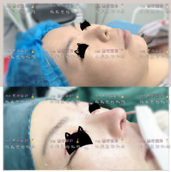 徐乃杰和汪福强谁做鼻子好