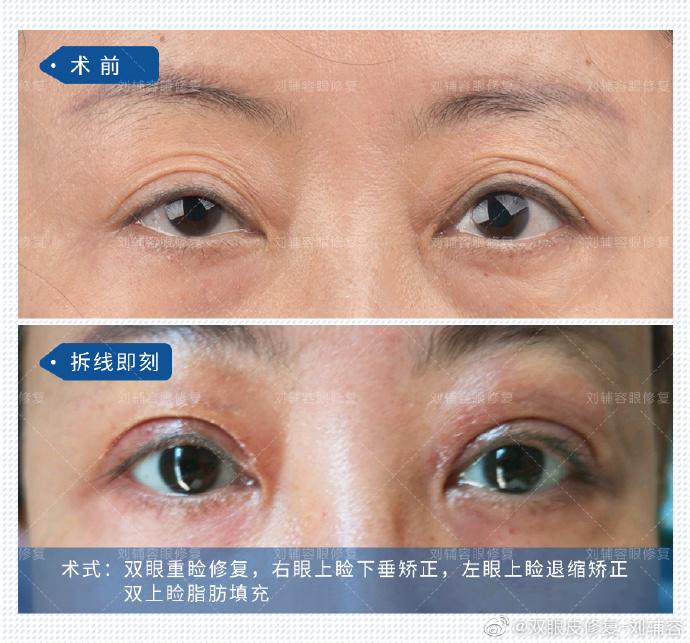 成都刘辅容双眼皮修复贵吗