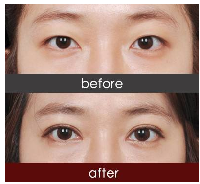 成都双眼皮手术哪家好，成都双眼皮医生排名