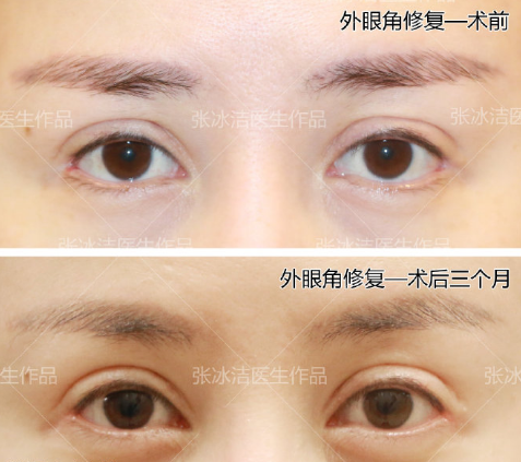 张冰洁和白永辉修复双眼皮哪个好