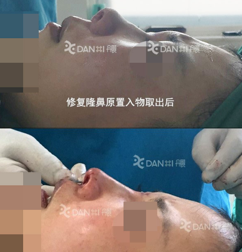 罗汇东、李劲良、李长赋哪个医生做鼻综合好？