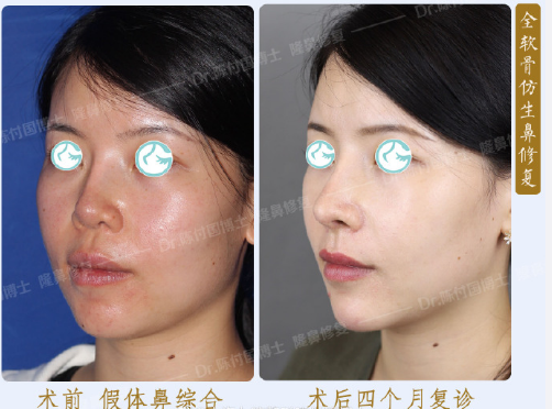 上海九院陈付国做鼻整形多少钱