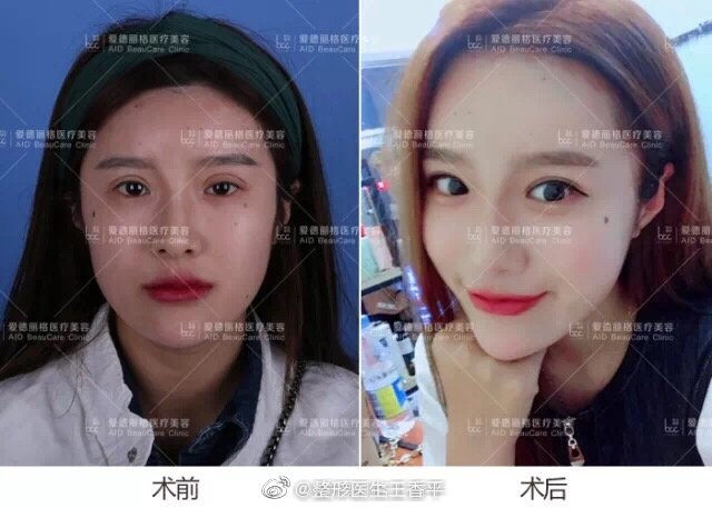 王香平做双眼皮和双眼皮修复怎么样