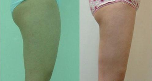 北京八大处马桂娥做大腿吸脂效果好吗？