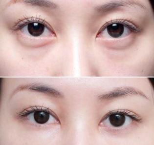 金国华和王海平哪个修复眼袋更好