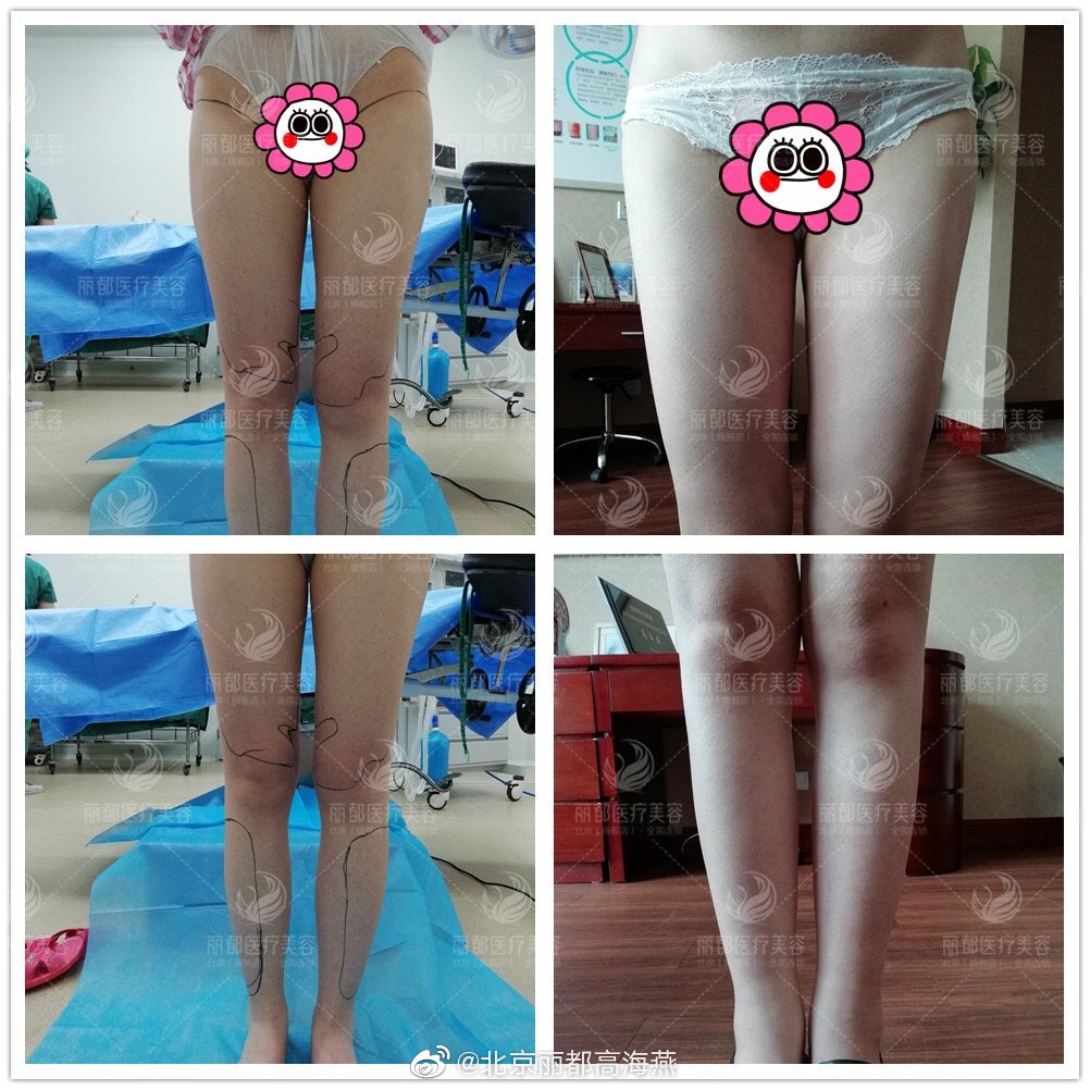 北京吸脂医生哪个最好