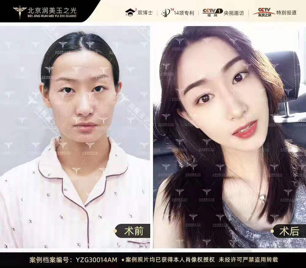 王明利和任学会哪个自体脂肪填充好