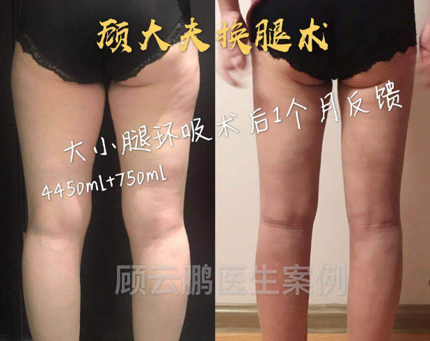 北京抽脂医生哪个最好