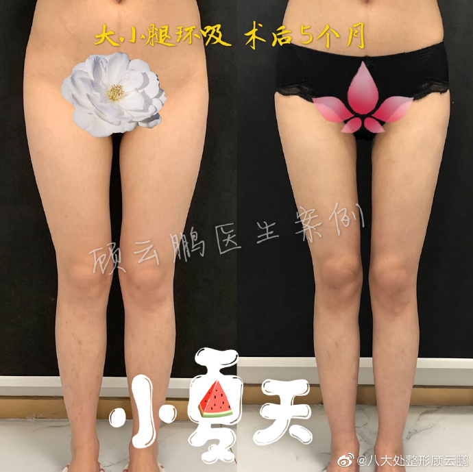 顾云鹏和胡守舵抽脂哪个效果好？用真实案例说话