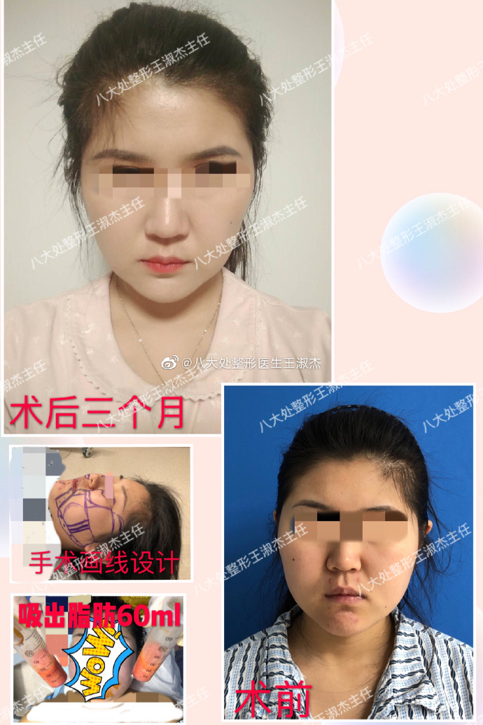 北京八大处王淑杰和李发成吸脂哪个好？