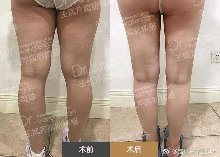 北京王凤芹吸脂和王东吸脂哪个好