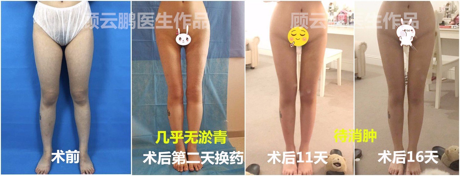 全国吸脂最有名的专家：顾云鹏和曹卫刚