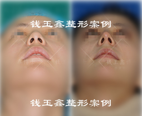 上海钱玉鑫和王艳哪个技术好做鼻子