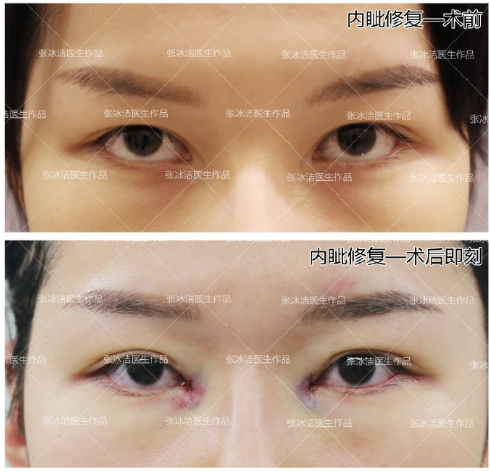 北京内眼角修复最好的医生