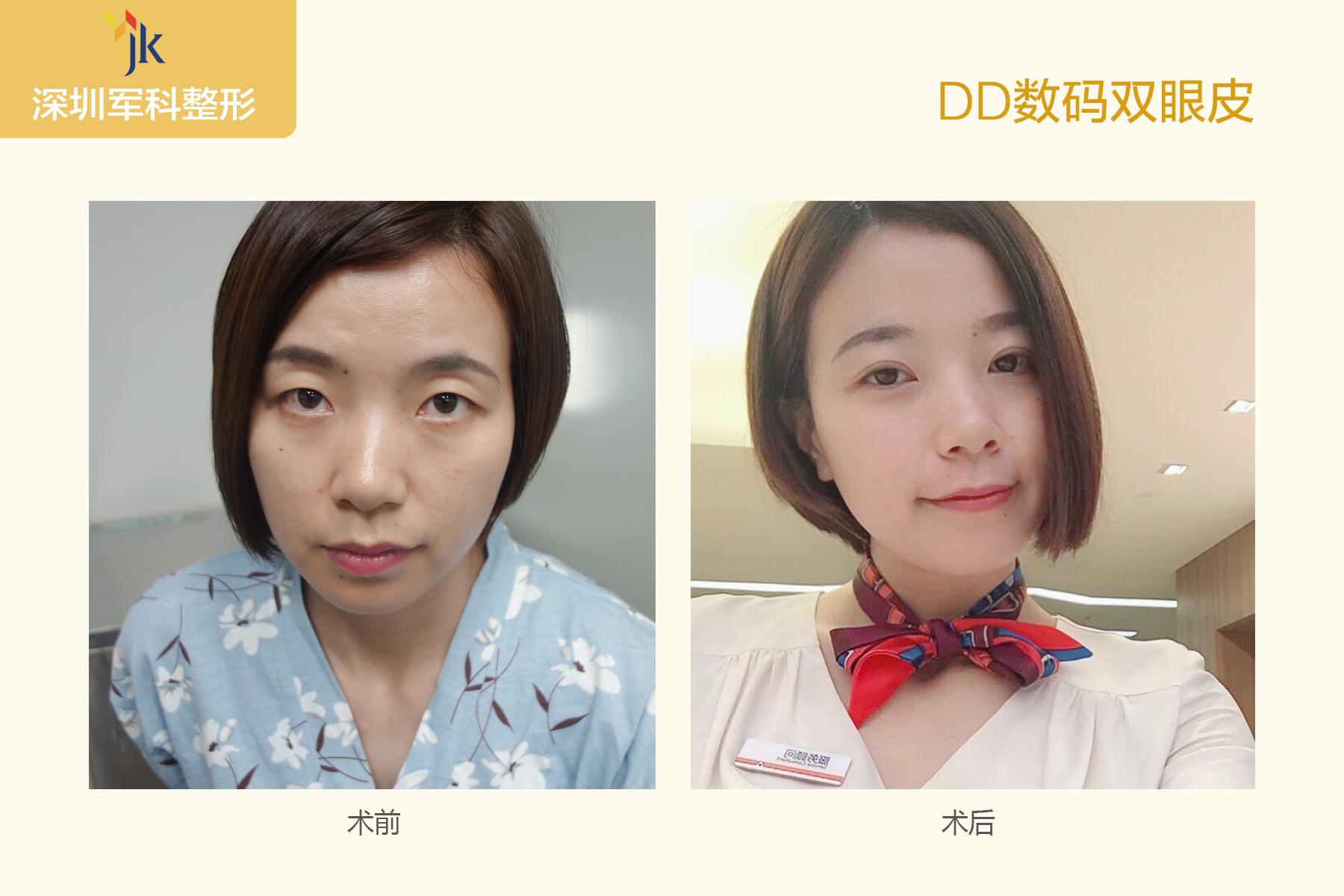 深圳双眼皮专家有哪些？刘月更和苗春来哪位医生更厉害？