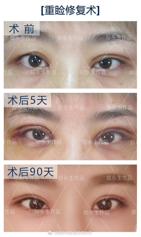 2020年郑永生跟王世勇哪个双眼皮修复好？