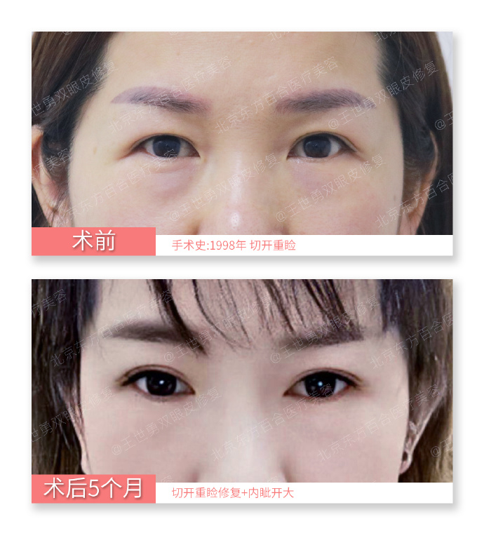 国内知名度较高双眼皮修复专家是谁