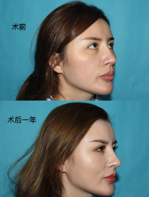 深圳隆鼻比较好的医生推荐