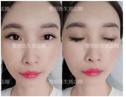 国内双眼皮修复最好的专家是哪个？