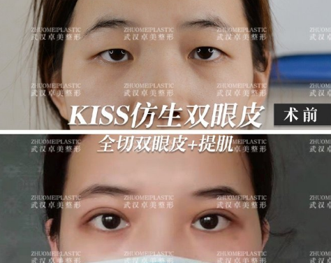 武汉双眼皮做的很好的医生有哪些