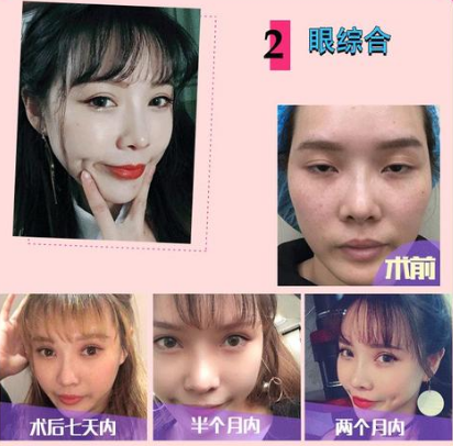 西安双眼皮手术谁做得最好