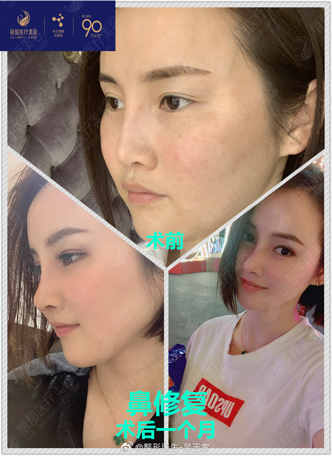 吴玉家做鼻修复技术靠谱吗？有人在那做过吗？