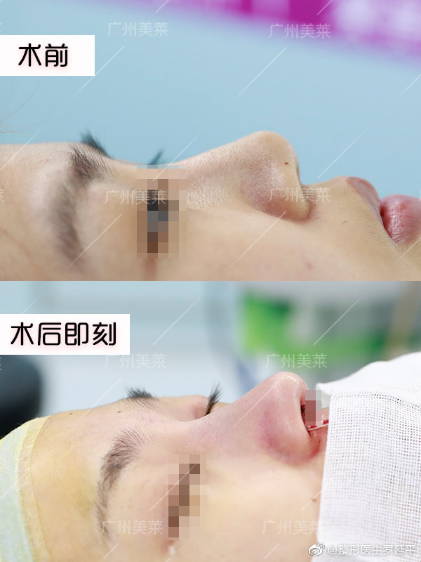 广州隆鼻比较好的医生是哪个？