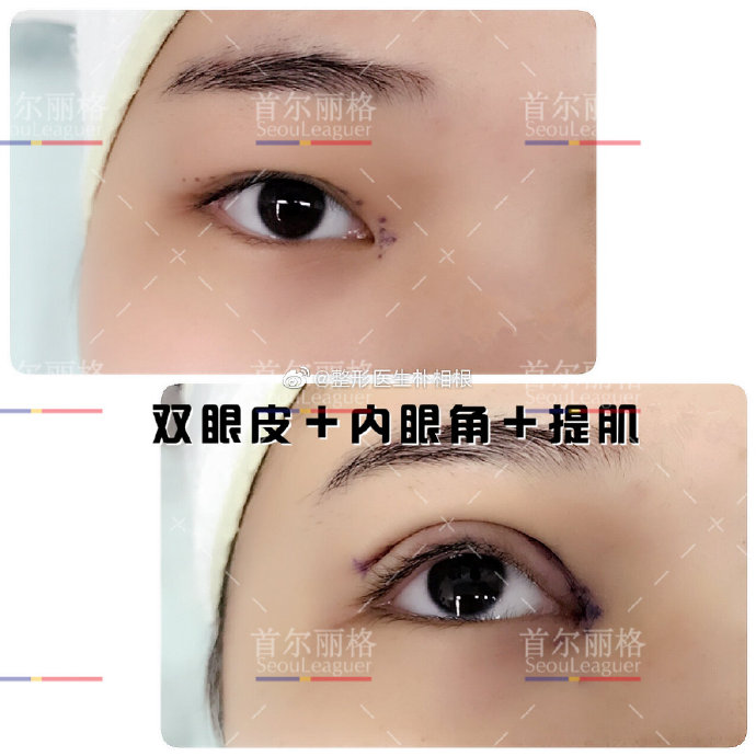 上海朴相根做双眼皮好看吗？有没有失败过？