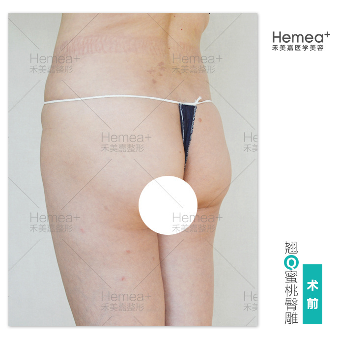 北京脂肪填充丰臀哪个医生最好？