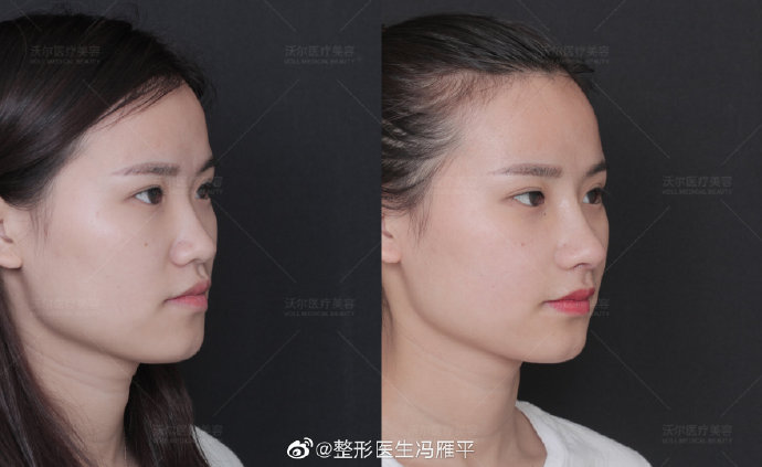 北京沃尔冯雁平做鼻尖鼻翼效果好不好？