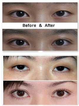 福州周亚宽割双眼皮技术怎么样