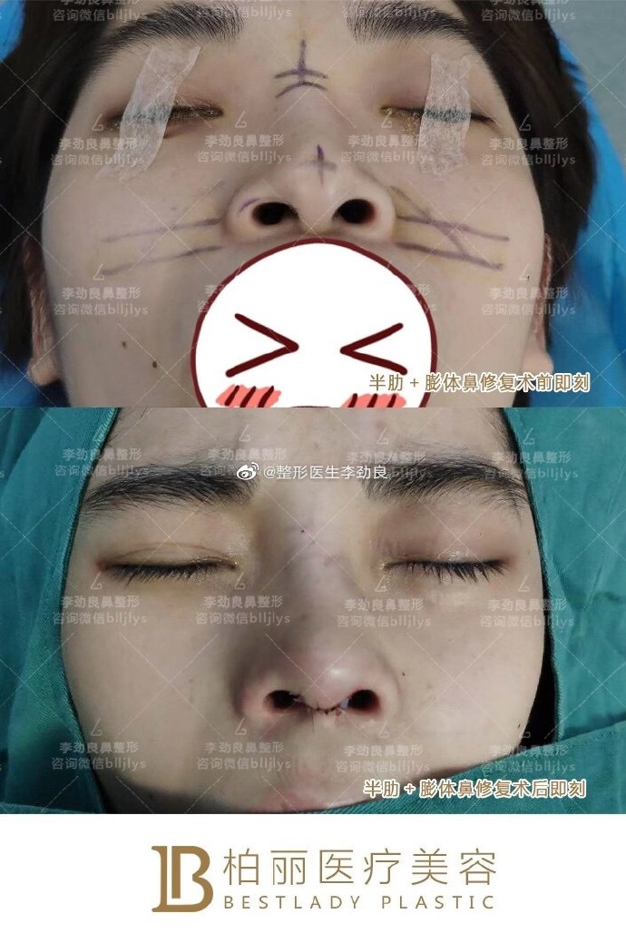 北京鼻修复李劲良和王志坚谁厉害