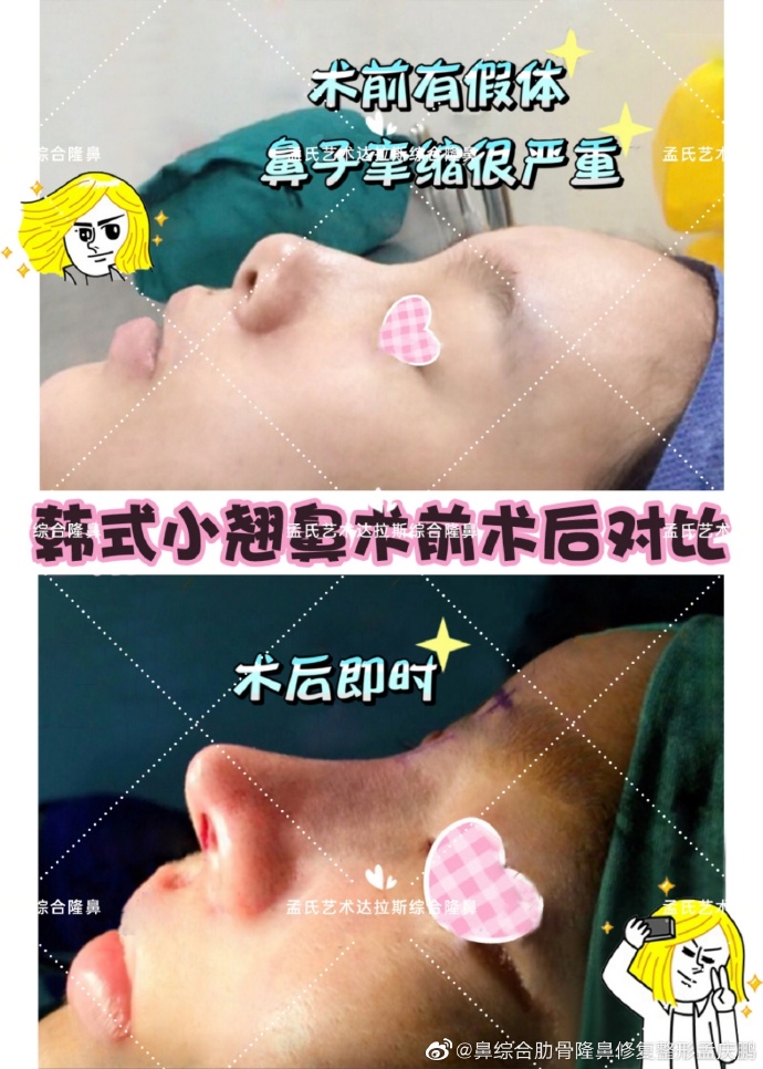 郑州孟庆鹏做鼻子怎么样