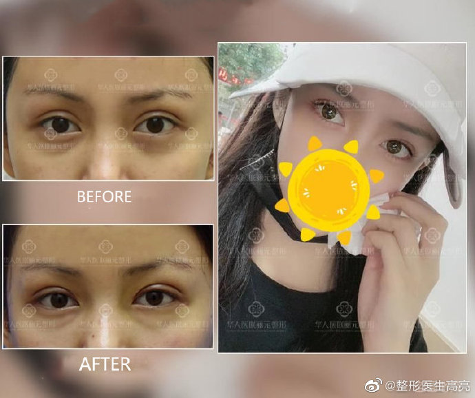 四川修复双眼皮高亮和文科哪个更好一些