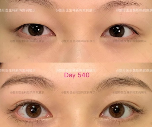 北京做双眼皮最好的专家是谁？