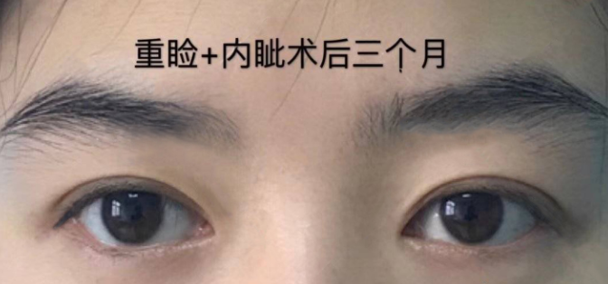 郑州割双眼皮医生哪个好