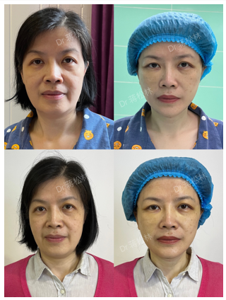 长沙蒋松林做膜力提升技术怎么样？蒋松林面部提升是什么技术？