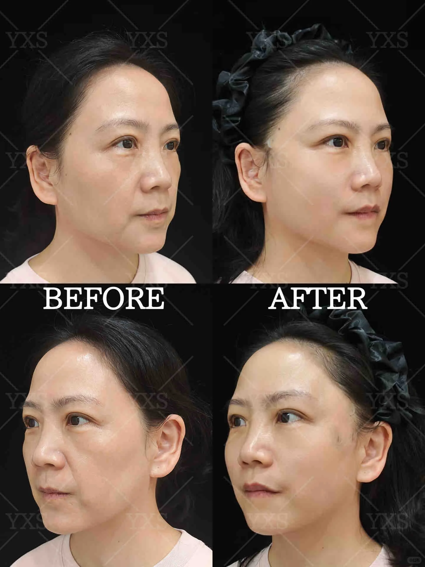 深圳面部年轻化专家高志文和王乙立做面部提升哪个技术好？高志文和王乙立预约咨询电话