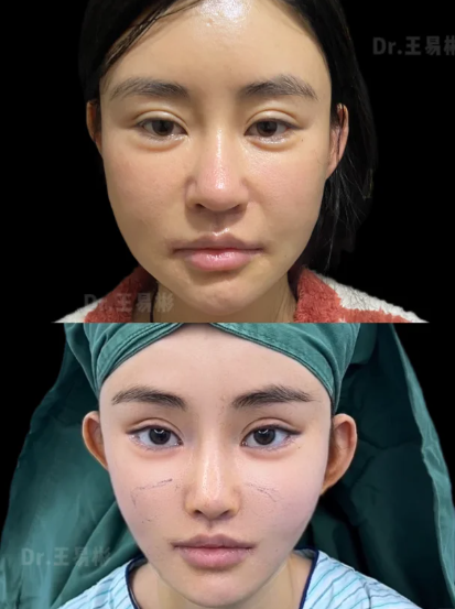 上海王易彬3D钻石网提升效果好不好？王易彬面部提升年轻化大概价位多少？