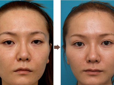 南昌哪个医生做双眼皮修复最厉害