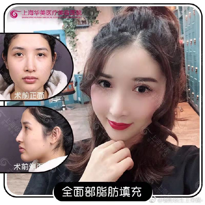 上海脂肪填充最好的医生是谁？