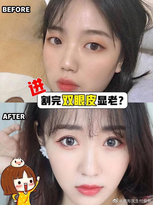 武汉付俊俐、李艳东、杨婓哪个双眼皮做的好