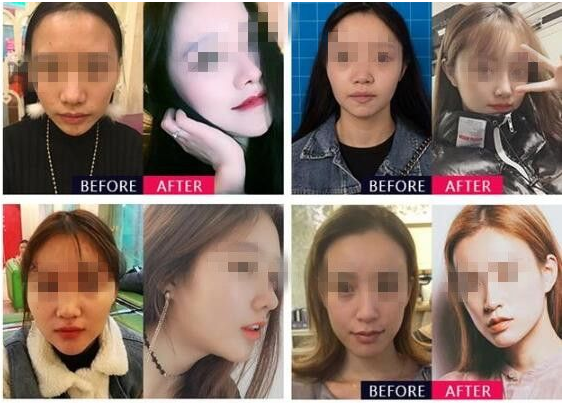 成都黄开亮和邓东伟哪个做鼻子好